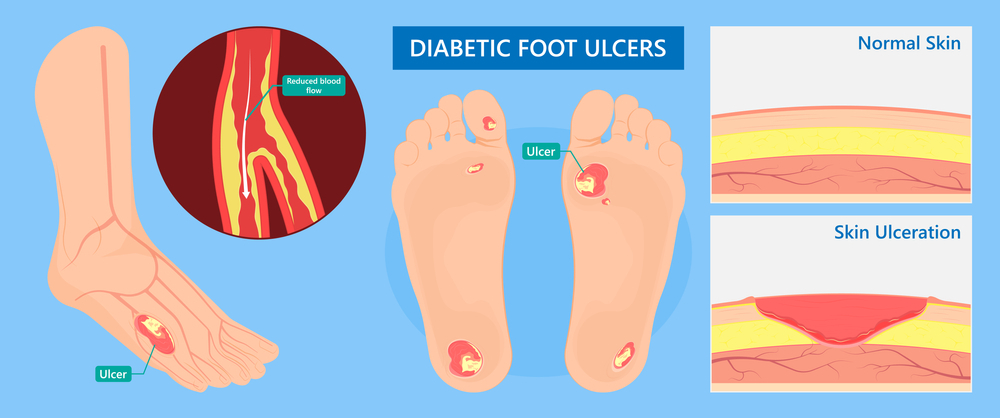 A multi centric study of diabetic foot ulcer: causes and complications |  Semantic Scholar
